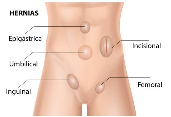 hernias abdominales | Proctóloga Santo Domingo